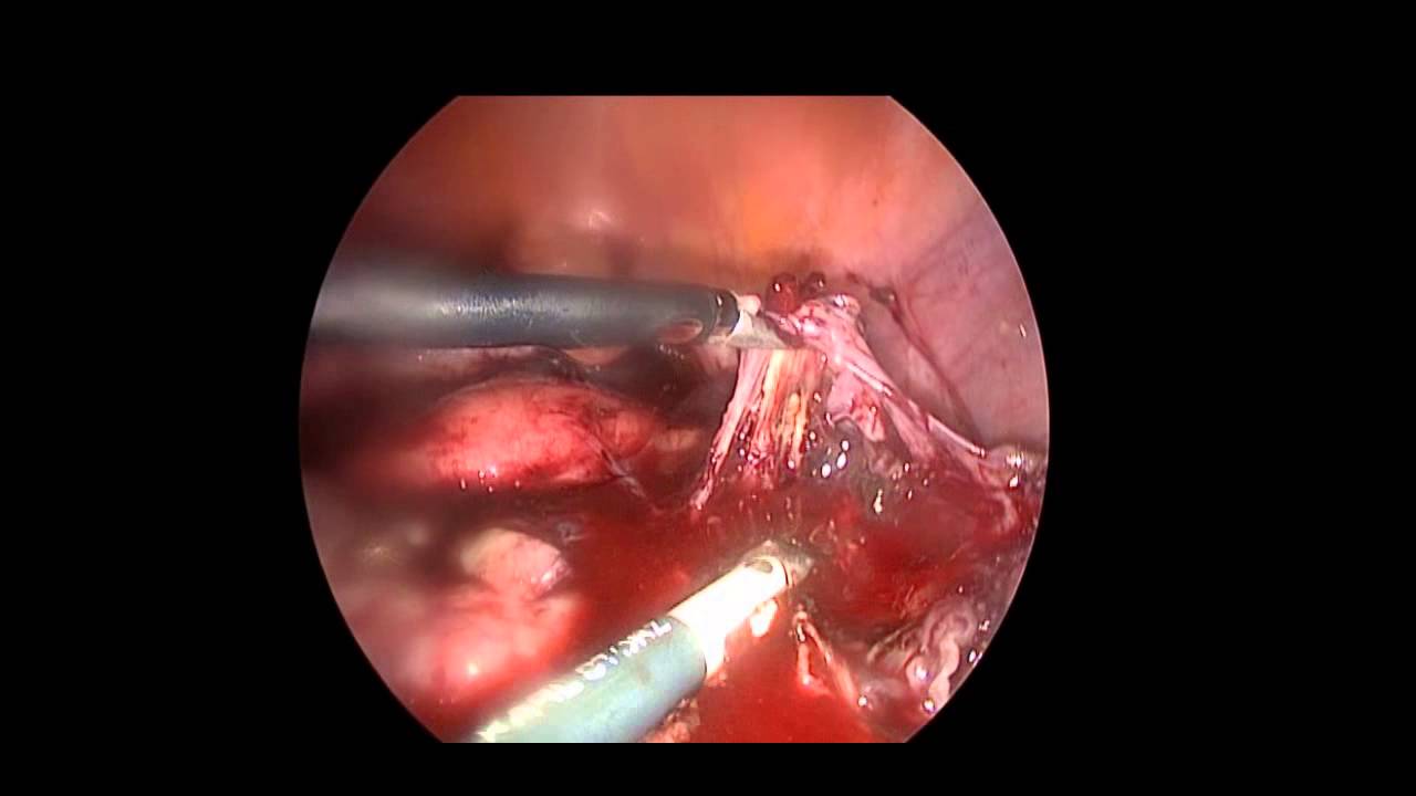 Laparoskopik Ovarian Drilling